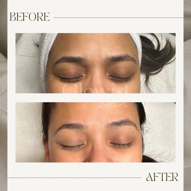 After first session of PDRN eye booster. For fresher, brighter and youthful looking under eyes