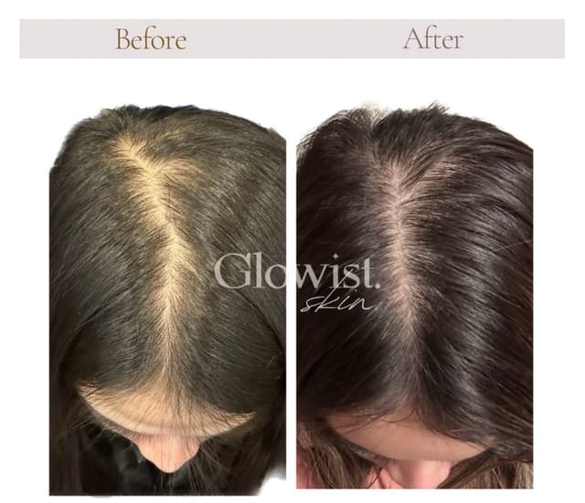After 3 sessions of Hair Restoration involves micro-injections of vitamins, peptides, and growth factors into the scalp to stimulate hair growth, strengthen thinning hair, and improve scalp health. Ideal for early hair loss or weakened hair, this non-surgical treatment boosts blood flow and revitalises hair follicles for fuller, healthier hair.