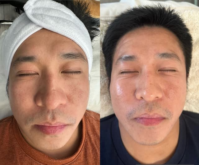 After 3 sessions of Microneedling