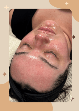 Dermaplane Facial