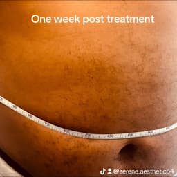 One week after Lemon Bottle fat dissolving injection at Serene Aesthetics in Stevenage – safe, nurse-led body contouring treatment showing visible inch loss and natural results.