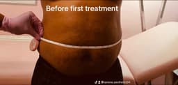 Before Lemon Bottle fat dissolving injection at Serene Aesthetics in Stevenage – safe, non-surgical treatment for targeted inch loss and body contouring.