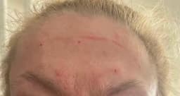 Immediately after anti-wrinkle injections at Serene Aesthetics in Stevenage – nurse-led treatment to smooth forehead lines safely, with minimal downtime.