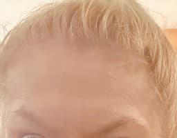 Two weeks after anti-wrinkle injections at Serene Aesthetics in Stevenage – smoother forehead, natural results, and a refreshed, youthful appearance with no downtime.