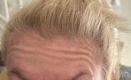 Before anti-wrinkle injections at Serene Aesthetics in Stevenage – visible forehead lines and wrinkles prior to treatment. A nurse-led approach ensures safe, natural results.