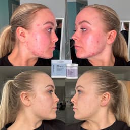 I've suffered with acne myself (top pics were May 2024) and this was 5 months of taking these 2 supplements that I have in clinic to get rid of acne!