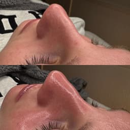 Blackhead removal included in every facial 🫧