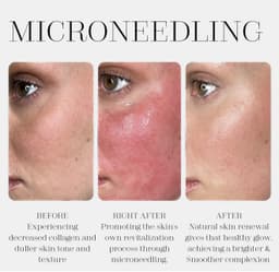 Microneedling before and after