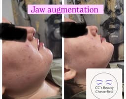 Before and after chin filler
