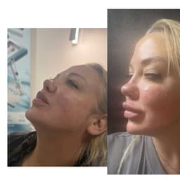 Before and after 5ml facial contour with filler