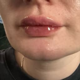 After 2ml lip filler done over 3 sessions