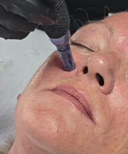 Microneedling