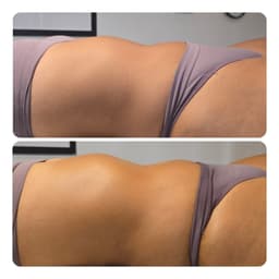 Brazillian Lymphatic Drainage