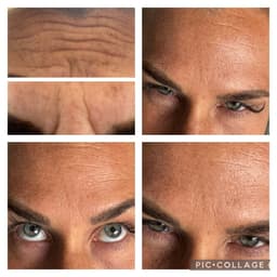 Anti wrinkle treatment before and after