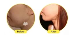 Lemon bottle fat dissolving