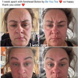 Botox