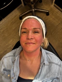 SkinPen  Mirconeedling