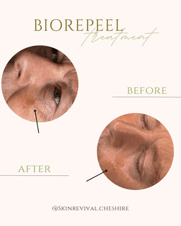 BioRePeel Facial- Targeted sunspot