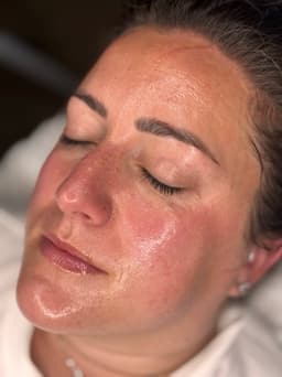 Microdermabrasion