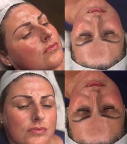 Dermaplaning Facial