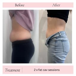 2 x sessions of fat cav
