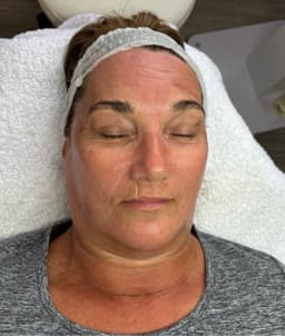 Microneedling X HydraFacial! A great combination for targeting all your skin concerns!