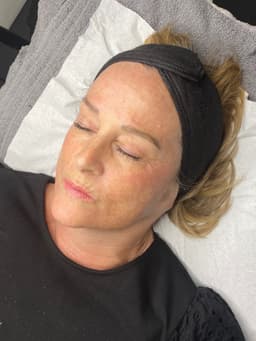Clients results after 1 treatment of micro-needling.