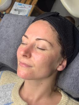 Advance facial after photograph - redness due to micro needling.